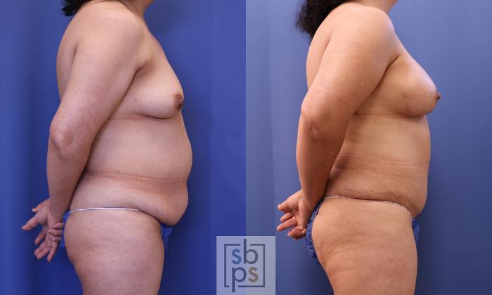 Before & After Breast Reconstruction Case 323 View #5 View in Torrance, CA