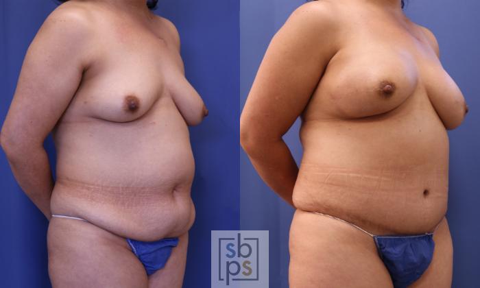 Before & After Breast Reconstruction Case 323 View #6 View in Torrance, CA