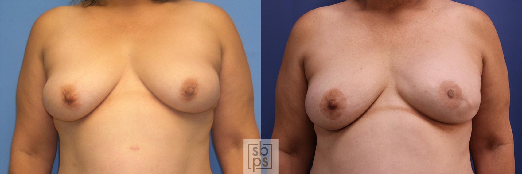 Before & After Breast Reconstruction Case 354 View #1 View in Torrance, CA