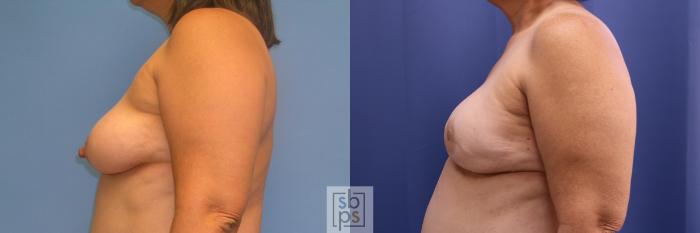 Before & After Breast Reconstruction Case 354 View #2 View in Torrance, CA