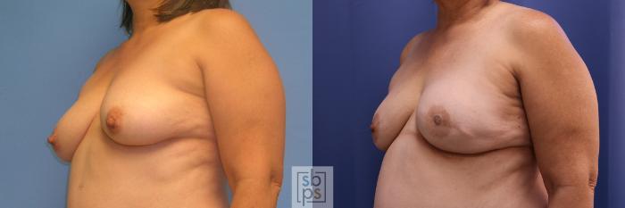 Before & After Breast Reconstruction Case 354 View #3 View in Torrance, CA
