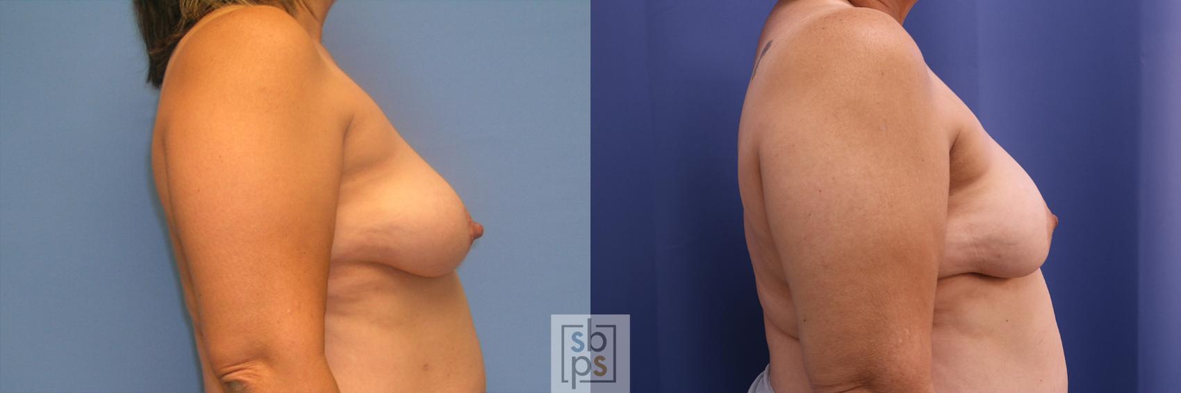 Before & After Breast Reconstruction Case 354 View #4 View in Torrance & Los Angeles, CA, CA