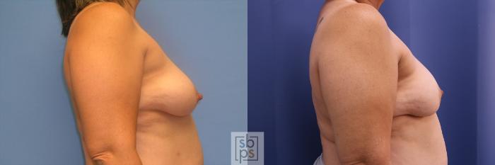 Before & After Breast Reconstruction Case 354 View #4 View in Torrance, CA