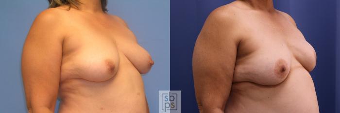 Before & After Breast Reconstruction Case 354 View #5 View in Torrance, CA