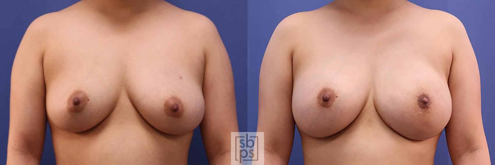 Before & After Breast Reconstruction Case 359 View #1 View in Torrance, CA