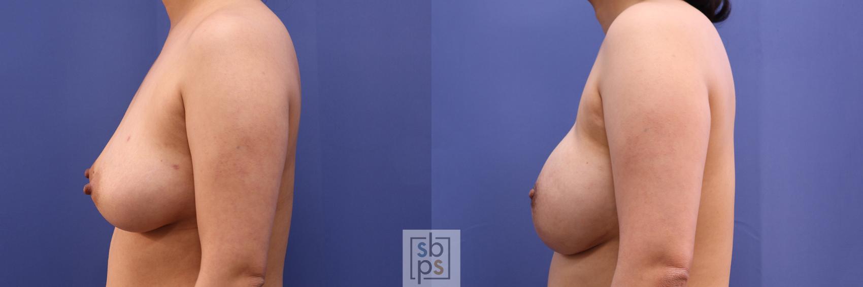 Before & After Breast Reconstruction Case 359 View #2 View in Torrance & Los Angeles, CA, CA