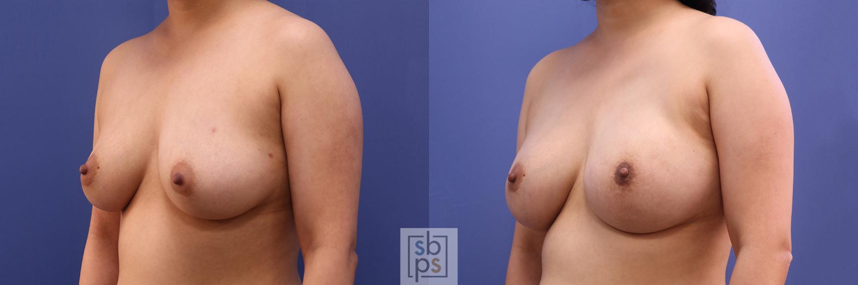 Before & After Breast Reconstruction Case 359 View #3 View in Torrance & Los Angeles, CA, CA