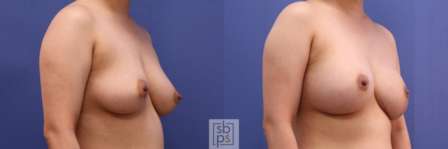 Before & After Breast Reconstruction Case 359 View #5 View in Torrance & Los Angeles, CA, CA