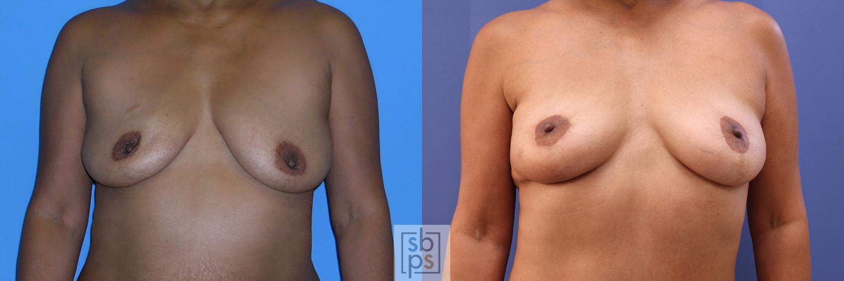 Before & After Breast Reconstruction Case 360 View #1 View in Torrance, CA