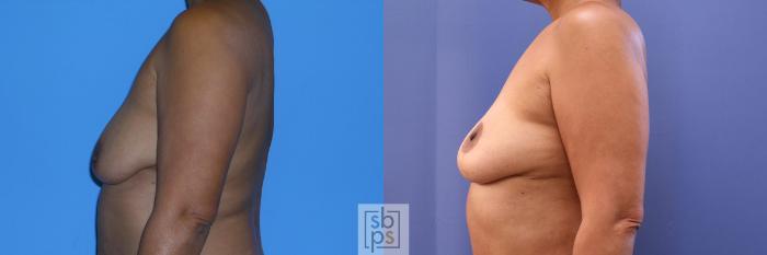 Before & After Breast Reconstruction Case 360 View #2 View in Torrance, CA