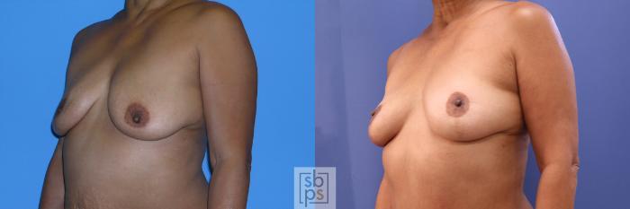 Before & After Breast Reconstruction Case 360 View #3 View in Torrance, CA