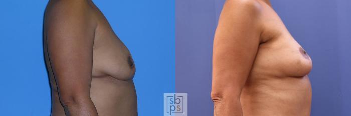 Before & After Breast Reconstruction Case 360 View #4 View in Torrance, CA