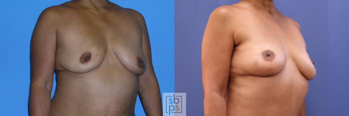 Before & After Breast Reconstruction Case 360 View #5 View in Torrance, CA