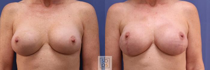 Before & After Breast Reconstruction Case 362 View #1 View in Torrance, CA