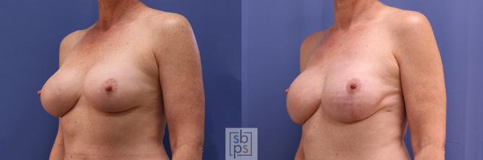Before & After Breast Reconstruction Case 362 View #3 View in Torrance, CA