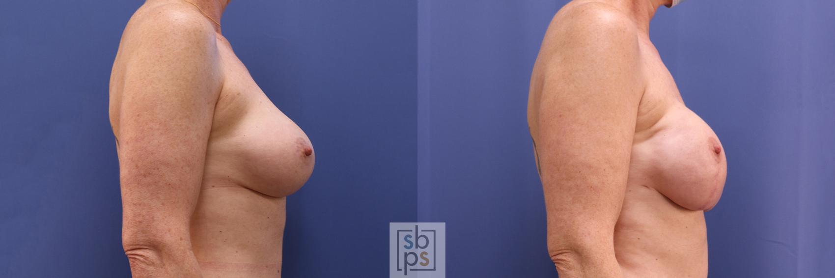 Before & After Breast Reconstruction Case 362 View #4 View in Torrance & Los Angeles, CA, CA