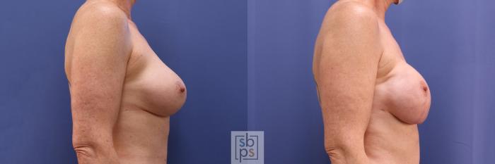 Before & After Breast Reconstruction Case 362 View #4 View in Torrance, CA
