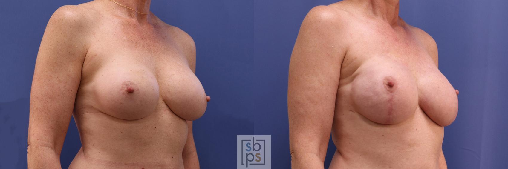 Before & After Breast Reconstruction Case 362 View #5 View in Torrance & Los Angeles, CA, CA