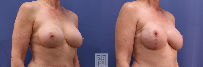Before & After Breast Reconstruction Case 362 View #5 View in Torrance, CA