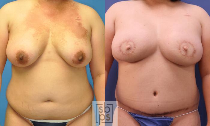 Before & After Breast Reconstruction Case 368 View #1 View in Torrance, CA