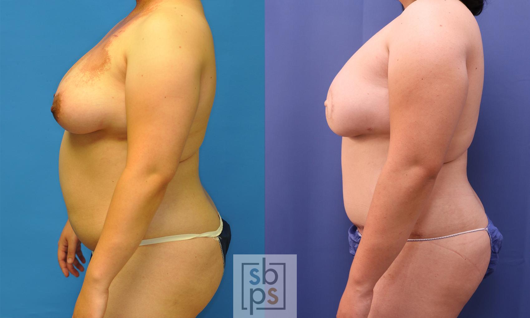 Before & After Breast Reconstruction Case 368 View #2 View in Torrance & Los Angeles, CA, CA