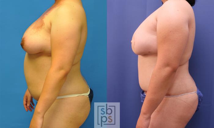 Before & After Breast Reconstruction Case 368 View #2 View in Torrance, CA