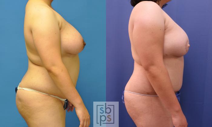 Before & After Breast Reconstruction Case 368 View #3 View in Torrance, CA