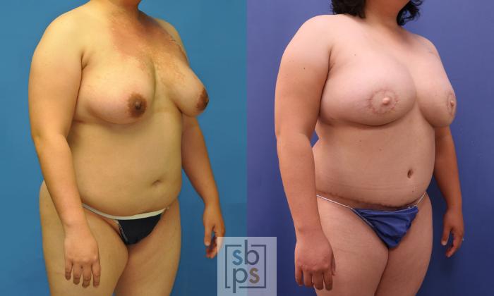 Before & After Breast Reconstruction Case 368 View #4 View in Torrance, CA