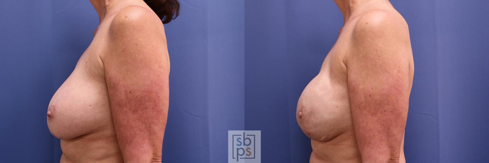 Before & After Breast Reconstruction Case 371 View #2 View in Torrance & Los Angeles, CA, CA