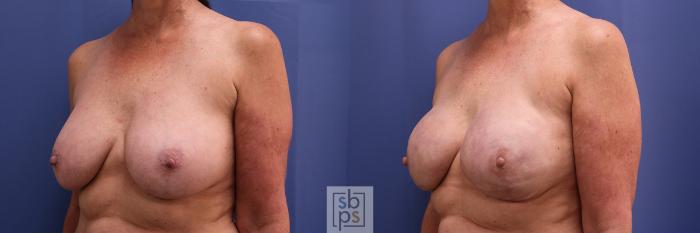 Before & After Breast Reconstruction Case 371 View #3 View in Torrance, CA