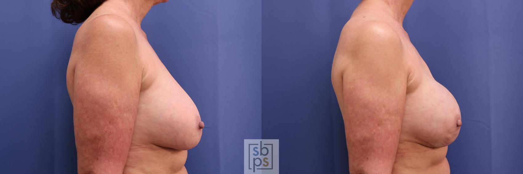 Before & After Breast Reconstruction Case 371 View #4 View in Torrance & Los Angeles, CA, CA
