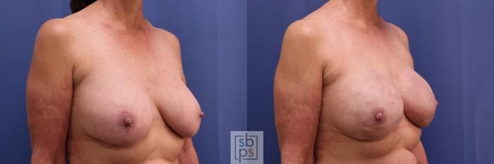 Before & After Breast Reconstruction Case 371 View #5 View in Torrance, CA