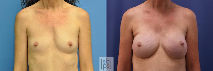 Before & After Breast Reconstruction Case 372 View #1 View in Torrance, CA