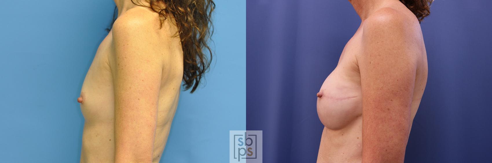 Before & After Breast Reconstruction Case 372 View #2 View in Torrance & Los Angeles, CA, CA