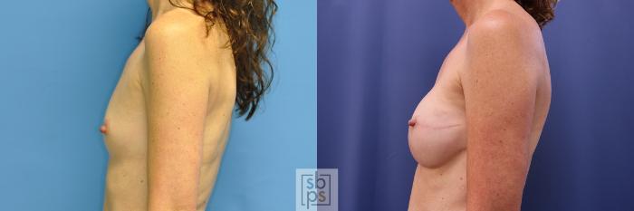Before & After Breast Reconstruction Case 372 View #2 View in Torrance, CA