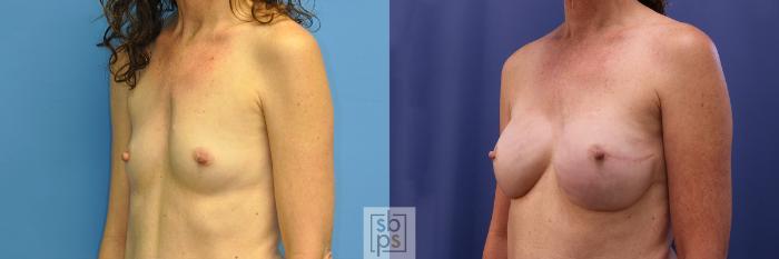 Before & After Breast Reconstruction Case 372 View #3 View in Torrance, CA