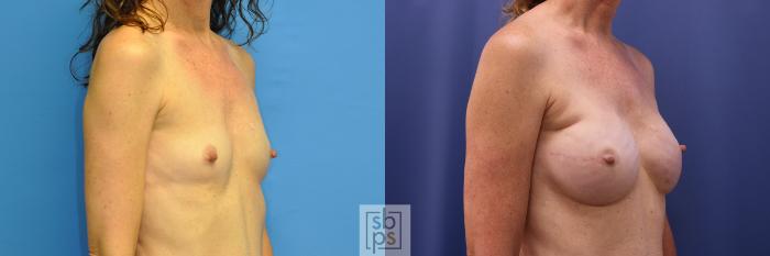 Before & After Breast Reconstruction Case 372 View #5 View in Torrance, CA