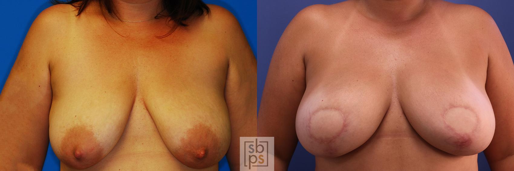 Before & After Breast Reconstruction Case 375 View #1 View in Torrance, CA