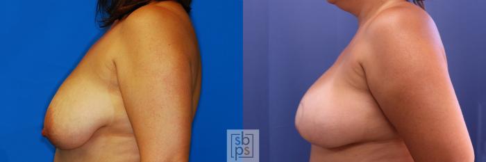 Before & After Breast Reconstruction Case 375 View #2 View in Torrance, CA