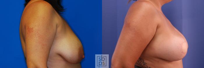 Before & After Breast Reconstruction Case 375 View #4 View in Torrance, CA