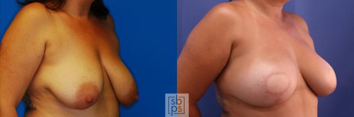 Before & After Breast Reconstruction Case 375 View #5 View in Torrance, CA