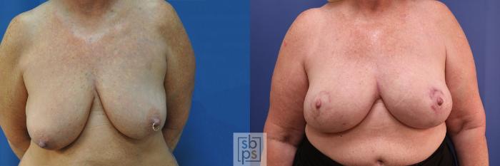 Before & After Breast Reconstruction Case 376 View #1 View in Torrance, CA