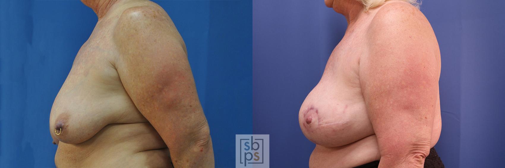 Before & After Breast Reconstruction Case 376 View #2 View in Torrance & Los Angeles, CA, CA