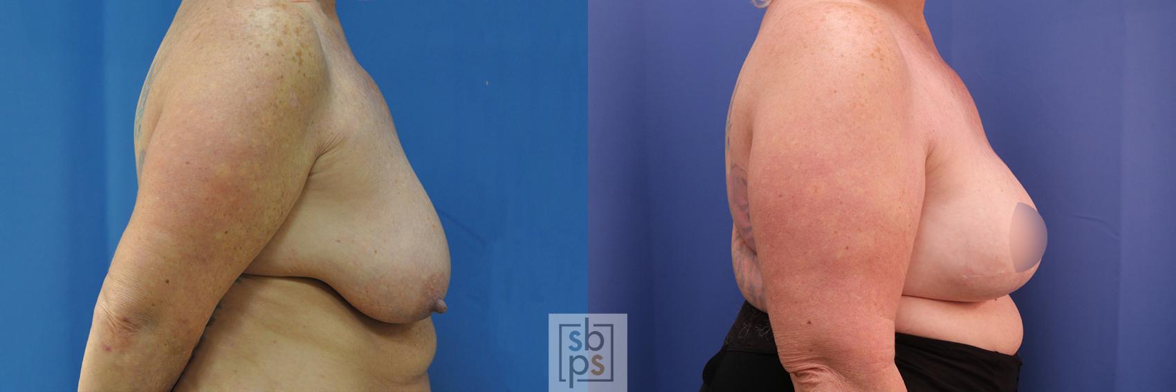 Before & After Breast Reconstruction Case 376 View #3 View in Torrance & Los Angeles, CA, CA