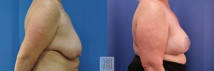 Before & After Breast Reconstruction Case 376 View #3 View in Torrance, CA