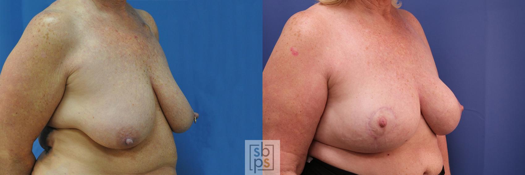 Before & After Breast Reconstruction Case 376 View #4 View in Torrance & Los Angeles, CA, CA
