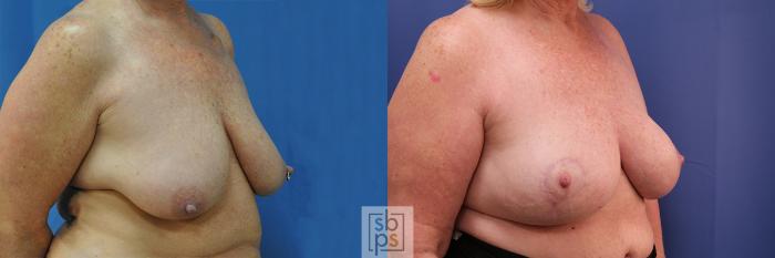 Before & After Breast Reconstruction Case 376 View #4 View in Torrance, CA