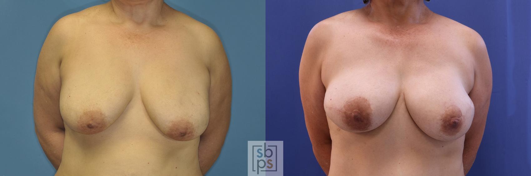 Before & After Breast Reconstruction Case 377 View #1 View in Torrance, CA