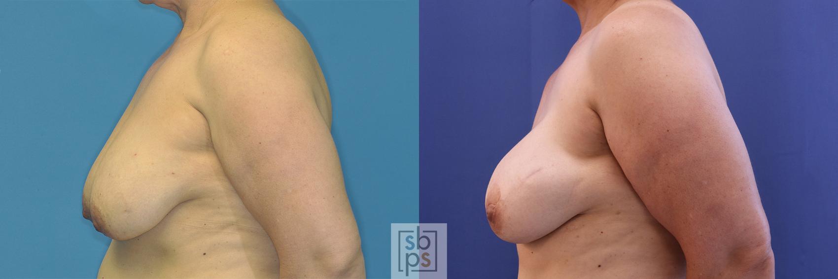 Before & After Breast Reconstruction Case 377 View #2 View in Torrance & Los Angeles, CA, CA