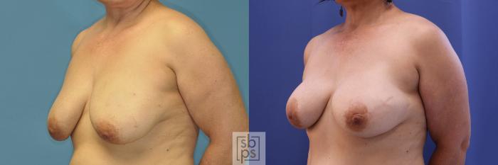 Before & After Breast Reconstruction Case 377 View #3 View in Torrance, CA